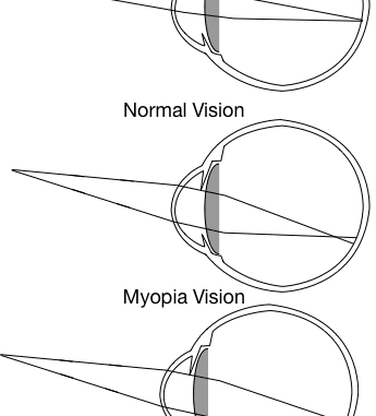 Myopia vs Hyperopia