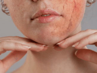 capillaries burst on face