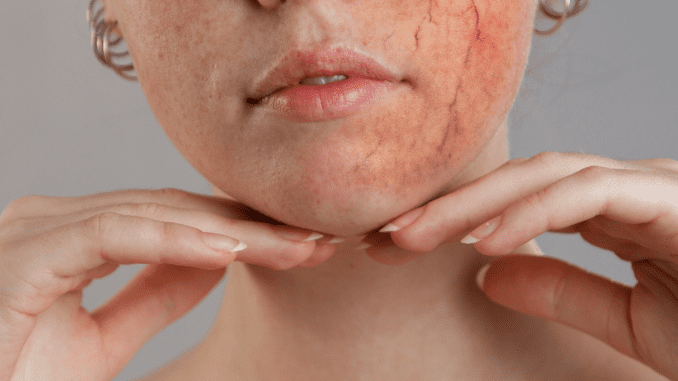 capillaries burst on face